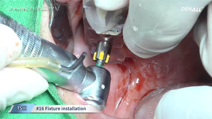 정현준 원장의 'Bilateral sinus graft and implantation with OneGuide System편 수술 장면.<오스템 제공>