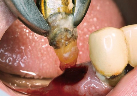 그림출처://images.fineartamerica.com/images-medium-large-5/premolar-tooth-extraction-dr-armen-taranyan--science-photo-library.jpg