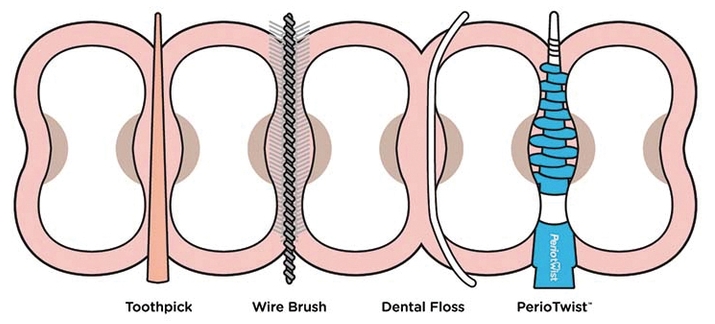 그림출처 : //media.oralhealthgroup.com/uploads/2016/07/Coopersmith-fig.4.jpg