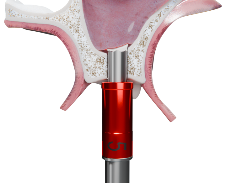 디오가 상악동 임플란트 시술을 보다 쉽고 안전하게 구현할 수 있는 혁신적 솔루션 ‘New Sinus Kit’를 출시했다.<디오 제공>