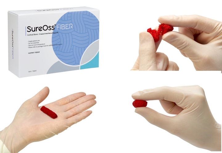 한스바이오메드는 최근 Cortical Fiber 100% 섬유형 골이식재 ‘슈어오스 파이버(SureOssⓇ FIBER)’를 출시했다.<한스바이오메드>