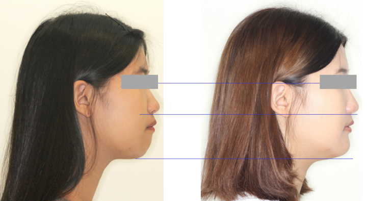 교정용 미니 임플란트로 전체 치열을 함입시켜 무턱환자의 안모를 개선하는 치료가 성인보다 청소년에게 효과가 크다는 국내 연구진의 발표가 해외 학계의 주목을 받았다.<저자 제공>