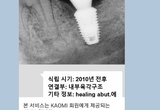 식립된 임플란트 찾아주기 서비스 인기