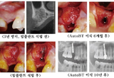 AutoBT 10년 장기 예후 우수성 입증
