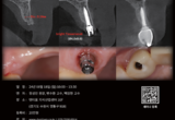 덴티움 'Bright Implant·CT' 임상 마스터 강연 '커밍 순'