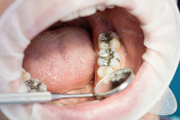 치협, 치과 내 보관 수은 현황 파악 나선다