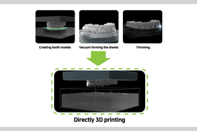 ODS, 10년 이상 임상 축적 투명교정 주목